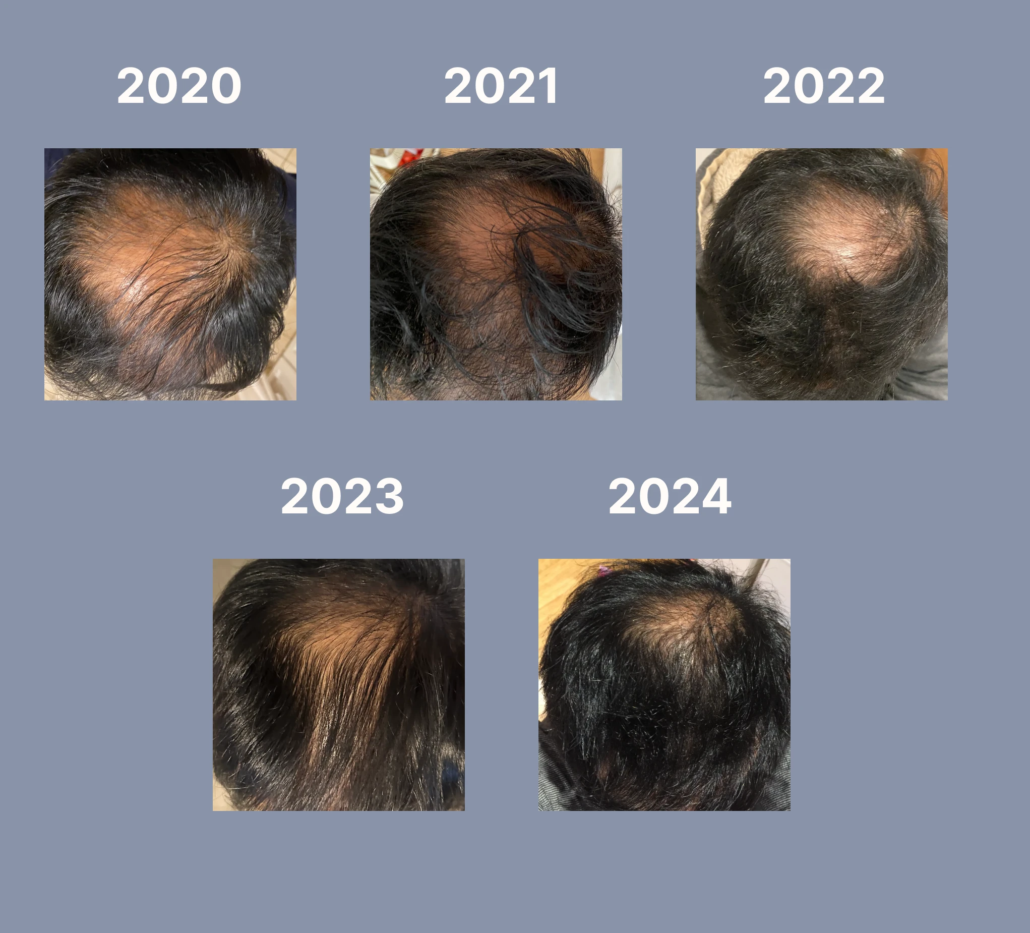 John's hair loss journey 2020 to 2024